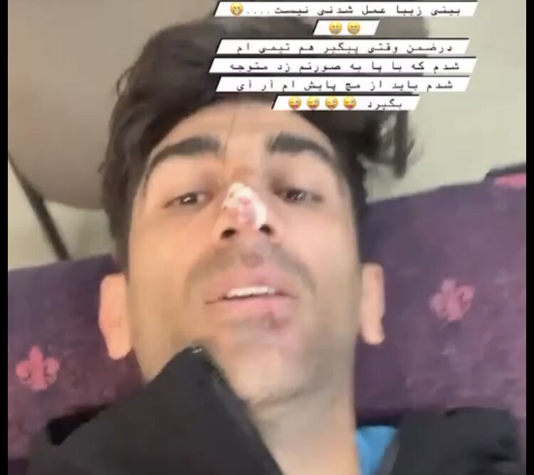 ویدیو| وقتی بینی بیرو، باعث مصدومیت پای هم‌تیمی‌اش شد