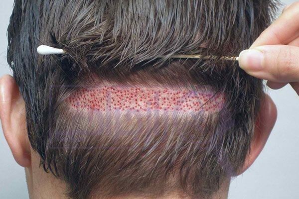 کاشت مو و ابرو در یک جلسه در راز جراحی