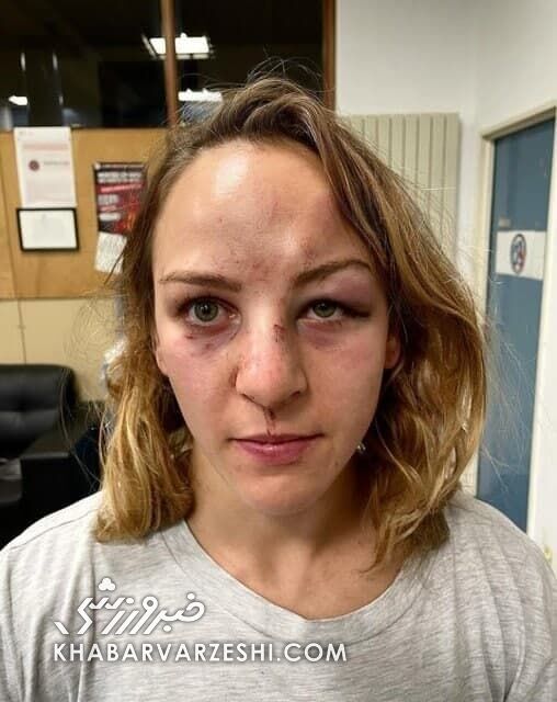 عکس| ملی پوش زن جودو بدجوری کتک خورد/ از ضرب و شتم شدید در منزل تا بازداشت نامزدی که حمله ور شد