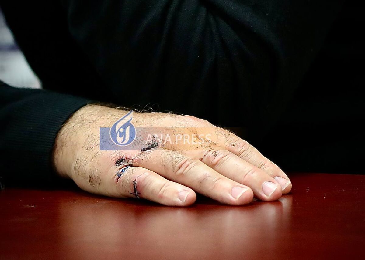 تصاویری از بخیههای عجیب روی دستان ساپینتو/ چه بلایی سر سرمربی استقلال آمد؟