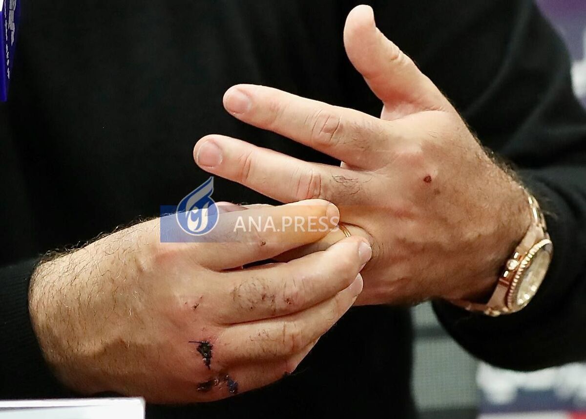 تصاویری از بخیههای عجیب روی دستان ساپینتو/ چه بلایی سر سرمربی استقلال آمد؟