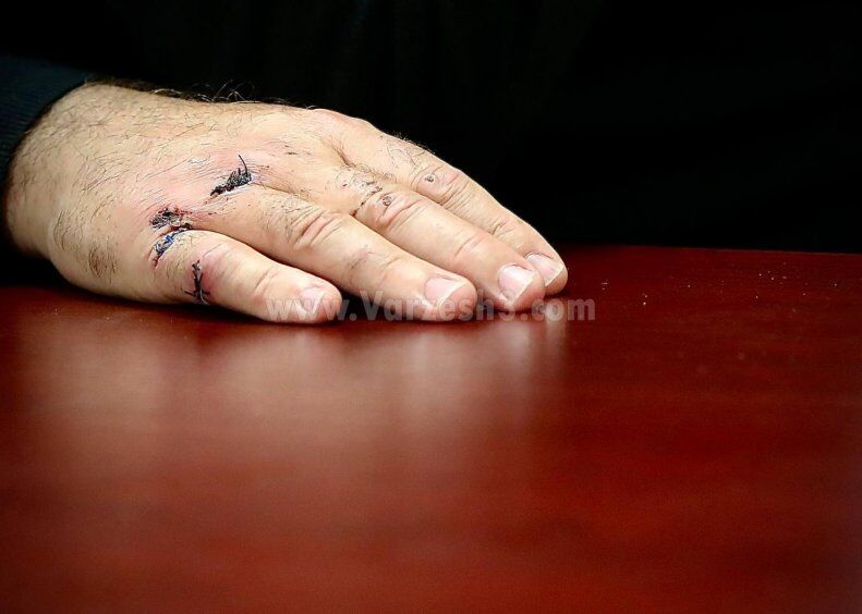 عکس| پشت پرده بخیههای دست ساپینتو/ مشت سرمربی استقلال به میز شیشهای؟