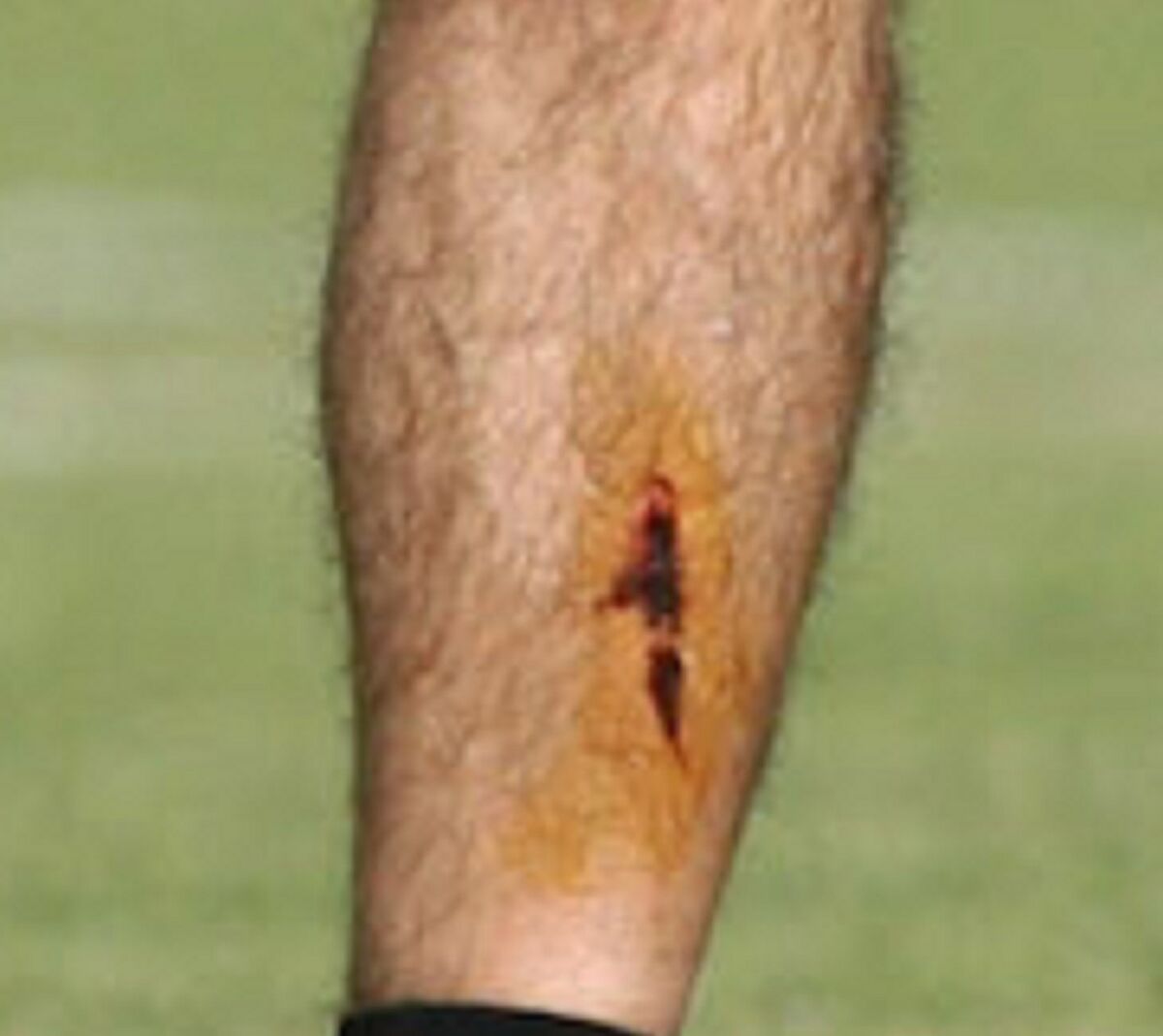 تصاویر| جراحت عجیب ساپینتو/ سرمربی استقلال مصدوم شد!