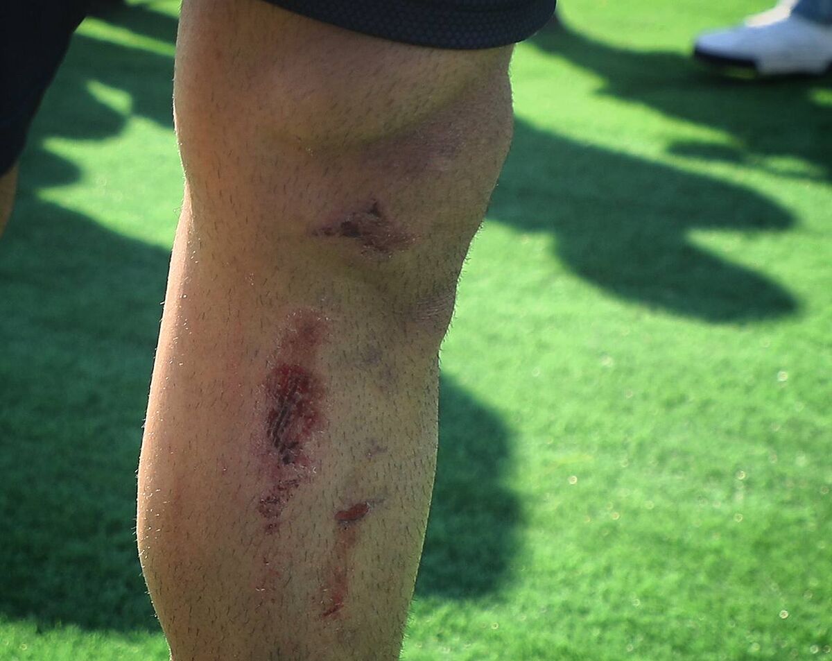 بیرانوند هواداران را به دلشوره انداخت/ تصاویر نگرانکننده از گلر تیم ملی