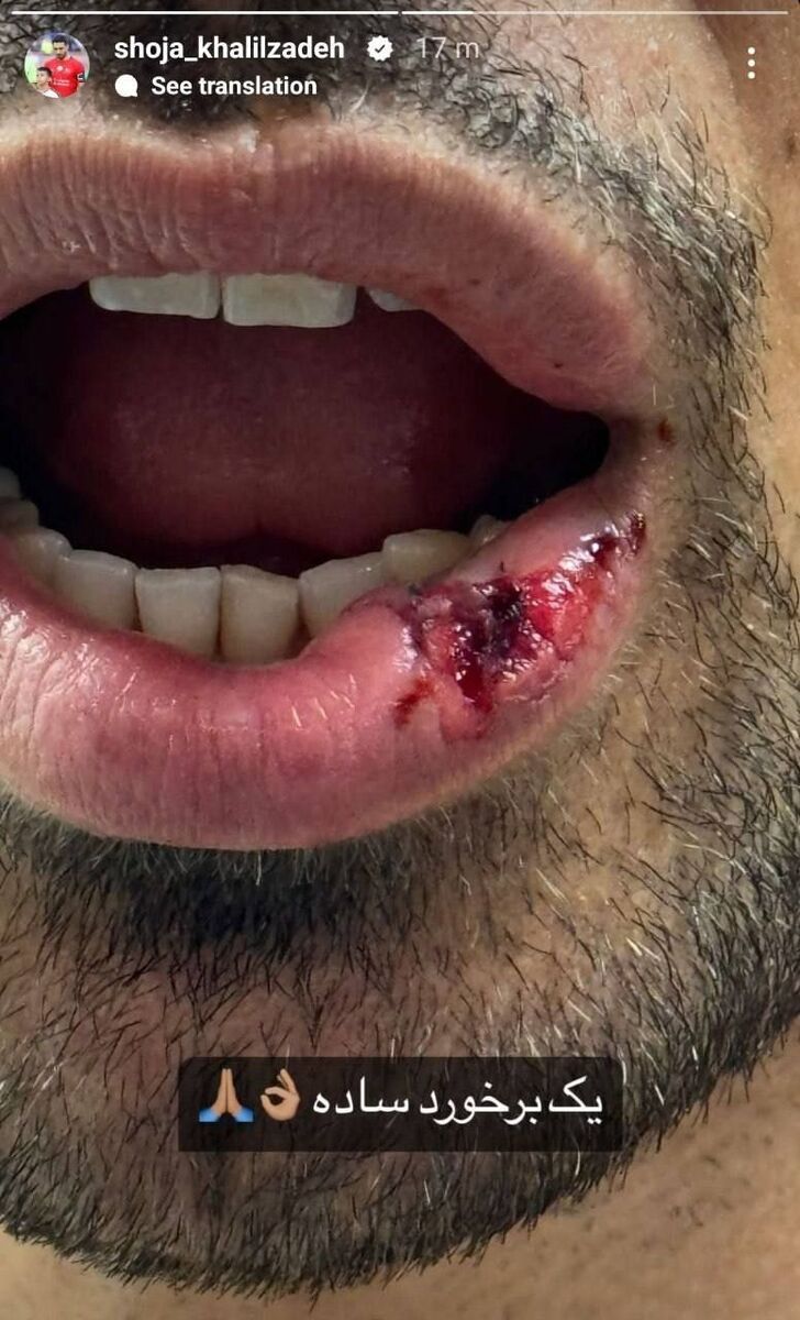 عکس| تصویری دردناک از بلایی که ستاره استقلال بر سر شجاع خلیلزاده آورد