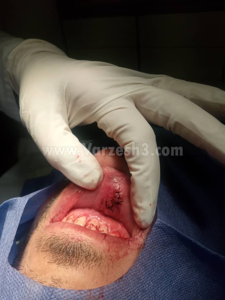 عکس| کار مدافع استقلالی به اتاق عمل کشیده شد