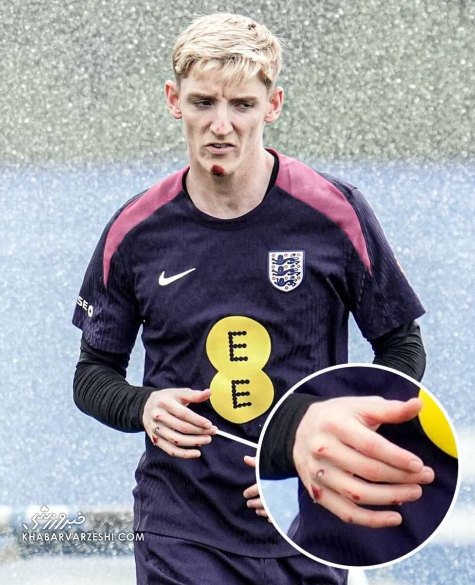 عکس| ستاره انگلیس به دلیل سقوط از دوچرخه مصدوم شد!