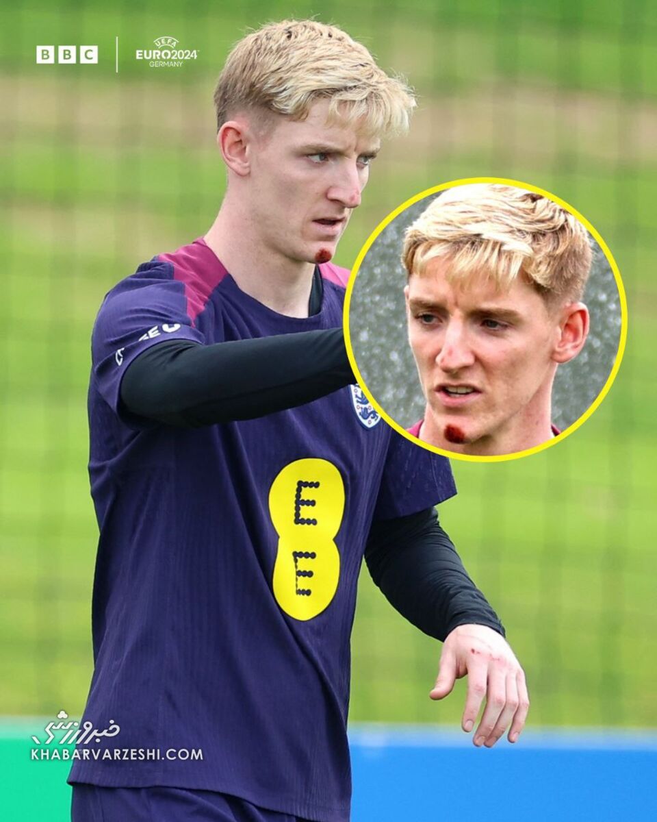 عکس| ستاره انگلیس به دلیل سقوط از دوچرخه مصدوم شد!