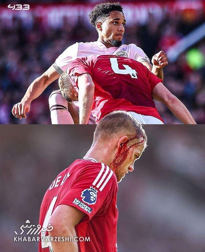 عکس| مصدومیت وحشتناک مدافع منچستریونایتد/ بازی با صورت خونآلود!