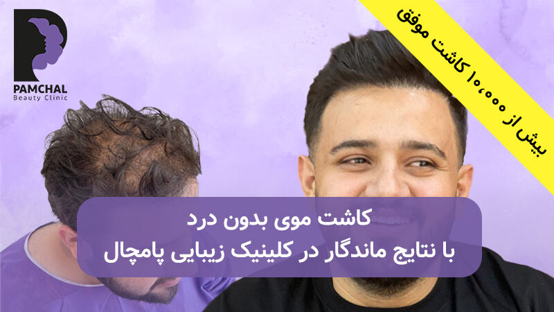 نمونه کاشت مو در کلینیک زیبایی پامچال