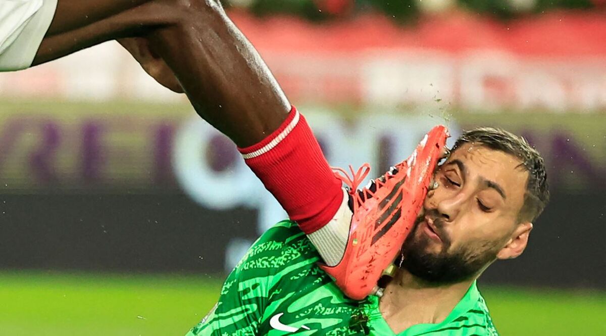 وضعیت صورت دوناروما بعد از آسیب وحشتناک/ هشدار تصویر دلهره آور! وضعیت صورت دوناروما بعد از آسیب وحشتناک/ هشدار تصویر دلهره آور!