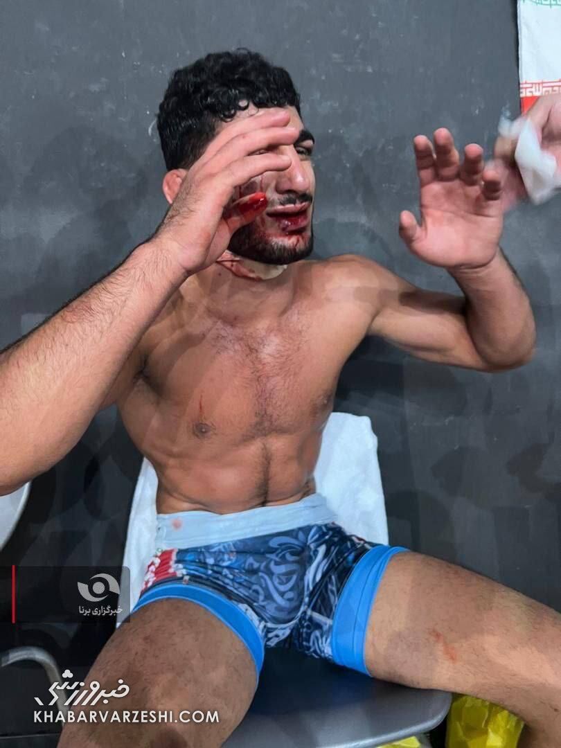 خونریزی صورت دانیال سهرابی