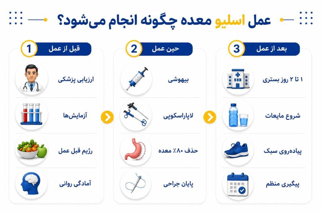 اسلیو معده