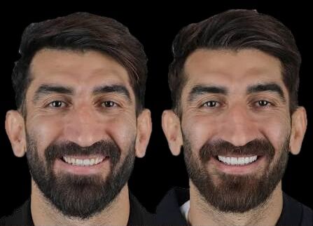 لبخند روی سکو چقدر آب می‌خورد؟ بررسی هزینه کامپوزیت، لمینت و ایمپلنت ورزشکاران