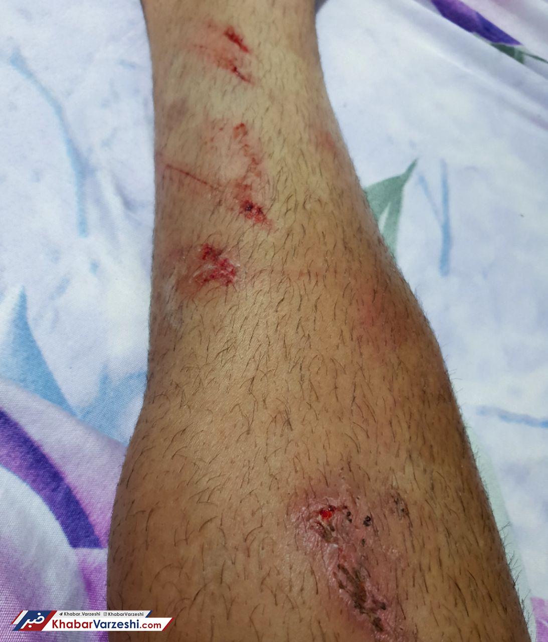 عکس| مصدومیت خونین شایان مصلح